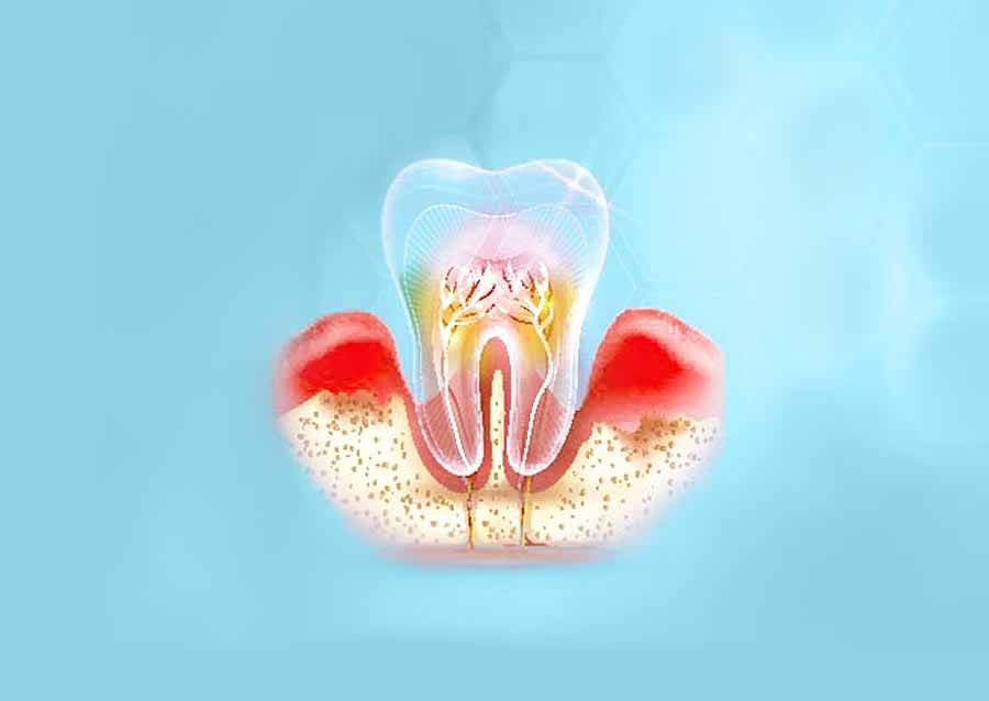 Zahnbetterkrankungen